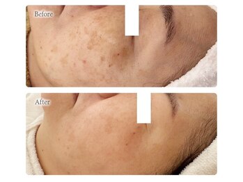 オービーエム 博多阪急店(O.B.M)/【40代シミケア症例】