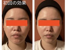 ロイヤリティ(ROYALTY)/フェイスライン/くいしばり/毛穴