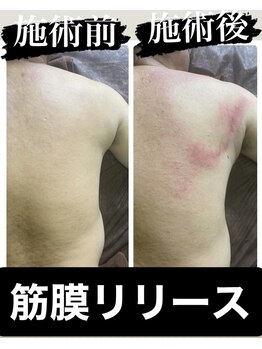 リベル(Liber)/筋膜リリース跡は1週間残ります