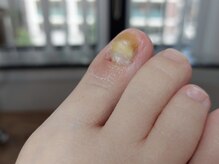 爪切り屋 足楽/変形爪【after】