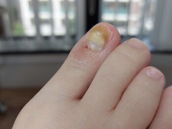 変形爪【after】