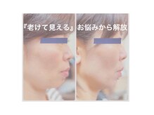 たるみの無いシャープなフェイスラインへ変化。