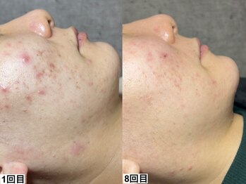 アンドミー 池袋(&me)/お肌の深いお悩みも徹底改善◎