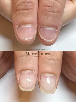 マリーロール 梅田店(Marie Laure)/自爪育成/深爪矯正/ネイルケア