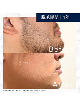 メンズクリア 武蔵小杉店/【メンズクリア】お客様の施術例