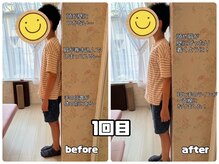 シャイン(Shine)の雰囲気（ストレートネックのお客様の姿勢矯正1回目のBefore/Afterです！）