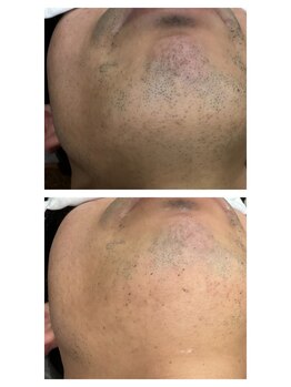 スキル アイラッシュ(SKILL eyelash)/メンズ脱毛☆ヒゲ脱毛