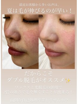 エリス(ELISSE)/ダブル脱毛で最短最速で減毛する