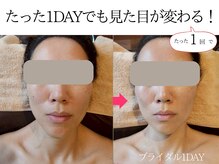 ヨンファテラピー 旗の台/before/after【旗の台/痩身】