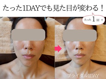 ヨンファテラピー 旗の台/before/after【旗の台/痩身】