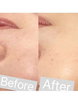 リンダ 西宮店(LINDA)/ハイドロフェイシャル