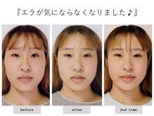 エピファニー(Epiphany)/20代　エラが悩みでした…