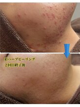 ラニ(Lani)/最新ハーブピーリングで肌質改善