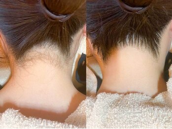 ライトウェーブ 松本村井本店/えり足脱毛 ビフォーアフター