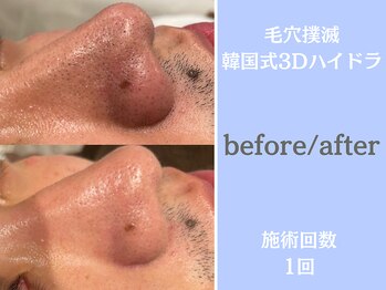ウィア 越谷店(Uvia)/毛穴汚れ・毛穴開き/新越谷駅