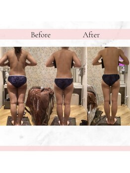 ソウイボディ 川崎本店(Sou-i body)の写真/理想の美脚へ…♪痩身開始【ハイパーナイフ+燃焼マッサージ45分¥2980】頑固なセル脂肪はプロが撃退!
