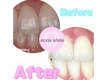 エクシアホワイトフジ(ecxia white fuji)/ホワイトニングビフォーアフター