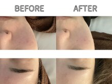 ライム 立川(LIME)/ハーブピーリング｜小顔