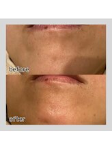 アデル 久留米(ADEL)/《全顔》顎下ワックス