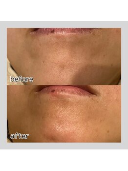 アデル 久留米(ADEL)/《全顔》顎下ワックス