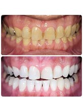 ホワイトニングセンター 広島福山駅前店/福山市・尾道市ホワイトニング