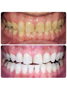 ホワイトニングセンター 広島福山駅前店/福山市・尾道市ホワイトニング