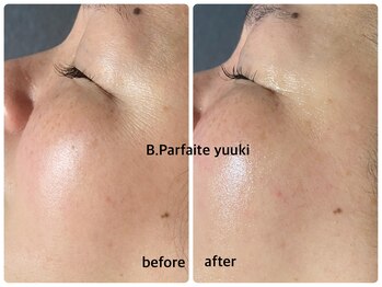 ビーパルフェット(B,Parfaite)/超音波エステ