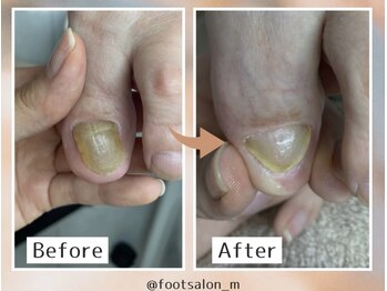 【肥厚爪】70代女性