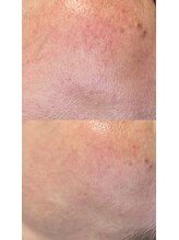 ラペカ(Lapeca)/開き毛穴やたるみ毛穴もお任せ♪