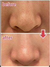 アンプリール(emplir)/毛穴の開き、黒ずみ、汚れ