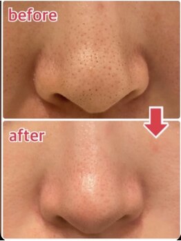 アンプリール(emplir)/毛穴の開き、黒ずみ、汚れ