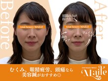 まいれ鍼灸院整骨院 整体院 草津院/美容鍼（むくみ/眼精疲労/頭痛）