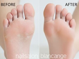 角質除去/フットケア/足裏ケア