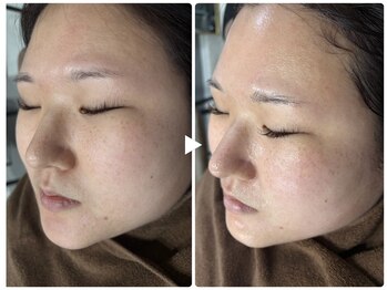 ナーススキン(nurse skin)の写真/《ララピール予約受付中！》韓国女優御用達の最新ピーリングを武庫之荘で♪ハリツヤUP、年齢肌にも◎