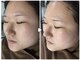 ナーススキン(nurse skin)の写真/《ララピール予約受付中！》韓国女優御用達の最新ピーリングを武庫之荘で♪ハリツヤUP、年齢肌にも◎