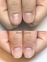 マリーロール 梅田店(Marie Laure)/自爪育成/深爪矯正/ネイルケア