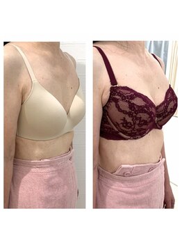 サロンドコーデ(salon de co-de)/バストアップ症例☆