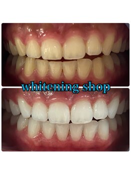 ホワイトニングショップ 盛岡店(WHITENINGSHOP)/妊娠中でも施術可能♪