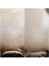 ミーミドットアイ(Mi-mi.i)/他サロン様で剛毛化、、