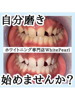 ホワイトパール 前橋(WhitePearl)/【ビフォーアフター】