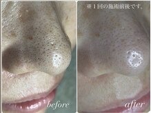 スパークル/毛穴ケア/フェイシャル/脱毛