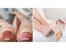 【フット巻き爪ケア】巻き爪矯正1本+フットケア¥12,500