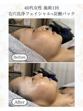 シーフェイス 横浜店(SEE FACE)/毛穴洗浄フェイシャル炭酸パック