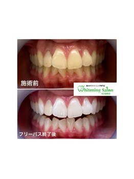 ホワイトニングサロン 名古屋駅店/【ホワイトニング施術例】