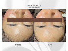 アン ビューティー(ann beauty)/施術1回【1ヶ月後ご来店時】10代