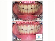 ホワイトニング専門店ホワイトニングビューティー東陽町【歯のホワイトニングサロン】/ホワイトニング