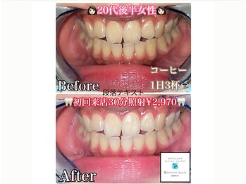 ホワイトニング専門店ホワイトニングビューティー東陽町【歯のホワイトニングサロン】/ホワイトニング