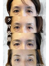 ルミライ(Lumirai)/たるみ改善|毛穴|フェイシャル