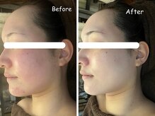 レイ(REI)/◆ニキビケア◆