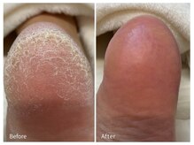 レフス 北参道店(REFUSS)/本格角質ケア